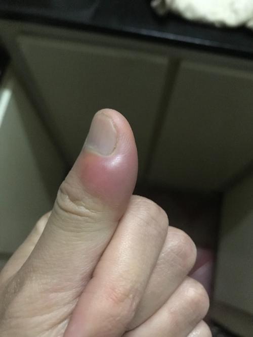 cc/右手大拇指红肿痛图片,右手大母指肿了是怎么回事