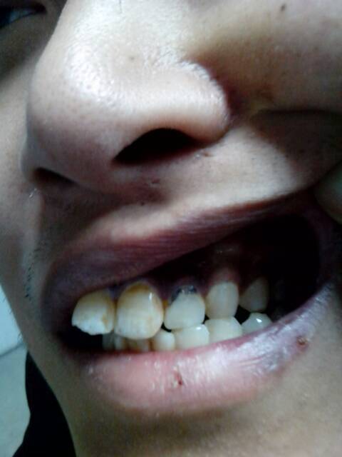 cc/牙齿根部黑腐蚀深图片,牙齿根部发黑腐蚀拔掉还是补