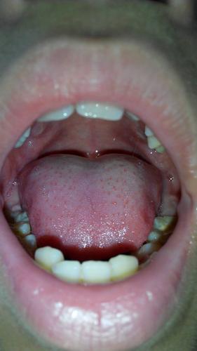 lw/舌头左边痛是什么原因