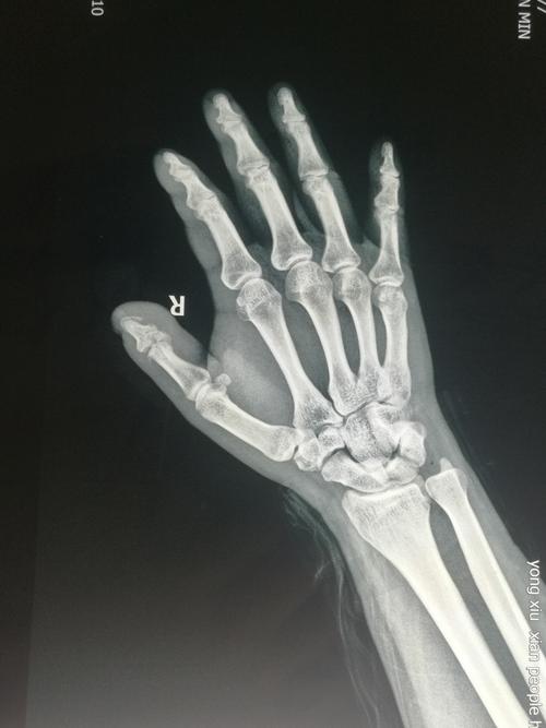 lw/指骨骨折x光片,手拇指骨折x光片子怎么看
