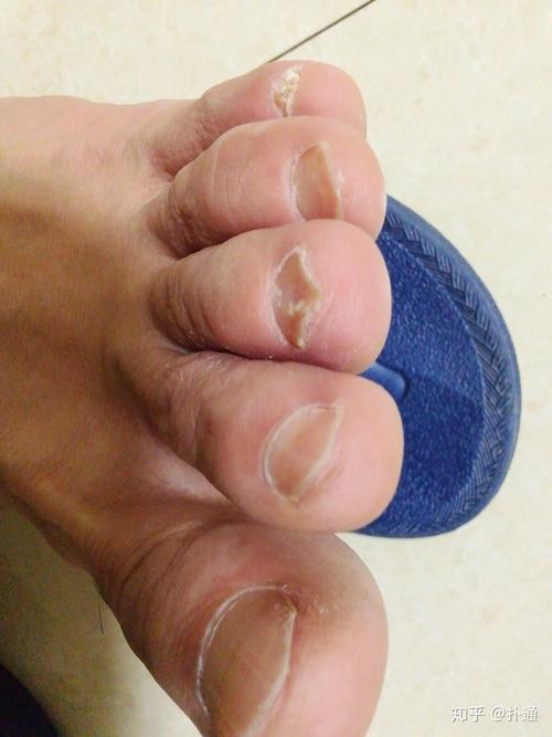 lw/脚指甲中间凹陷一条痕,脚指甲中间凹下去一条线是为什么