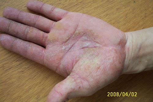lw/苔藓皮肤病有哪几种,苔藓皮肤病是怎么形成的