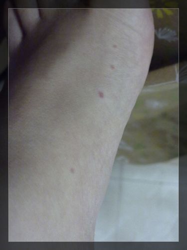 lw/蚊子叮咬的小红点,蚊子叮咬小红点怎么治疗