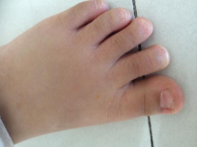 发现儿童脚趾甲凹陷是怎么回事呢？这种情况严重吗？的相关图片