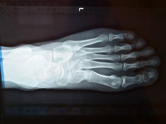 急！脚趾骨折X光，求专家指点，万分感谢！的相关图片