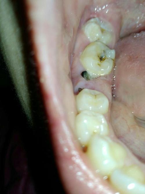 牙齿根部好想被腐蚀了一样有一条小缝隙，这是什么情况啊？的相关图片