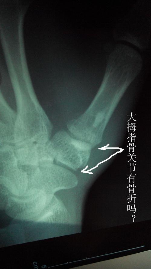 请教名医：下面这张左手X光照片显示的是否“大拇指骨关节有骨折”？本人看不懂，所以请教请教。谢谢！的相关图片